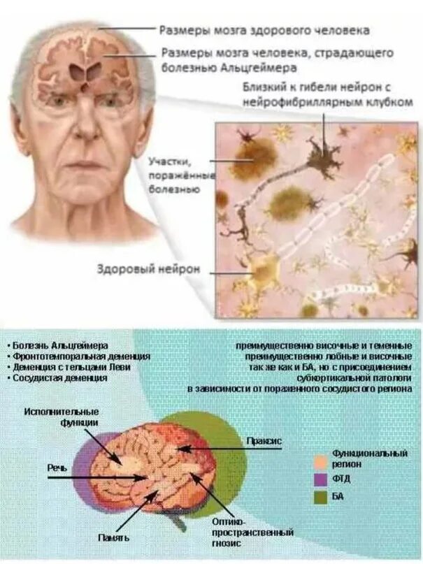 Деменция головы. Болезнь Альцгеймера. Болезнь Альцгеймера мозг. Болезнь Альцгеймера симптомы. Мозг больного Альцгеймером.