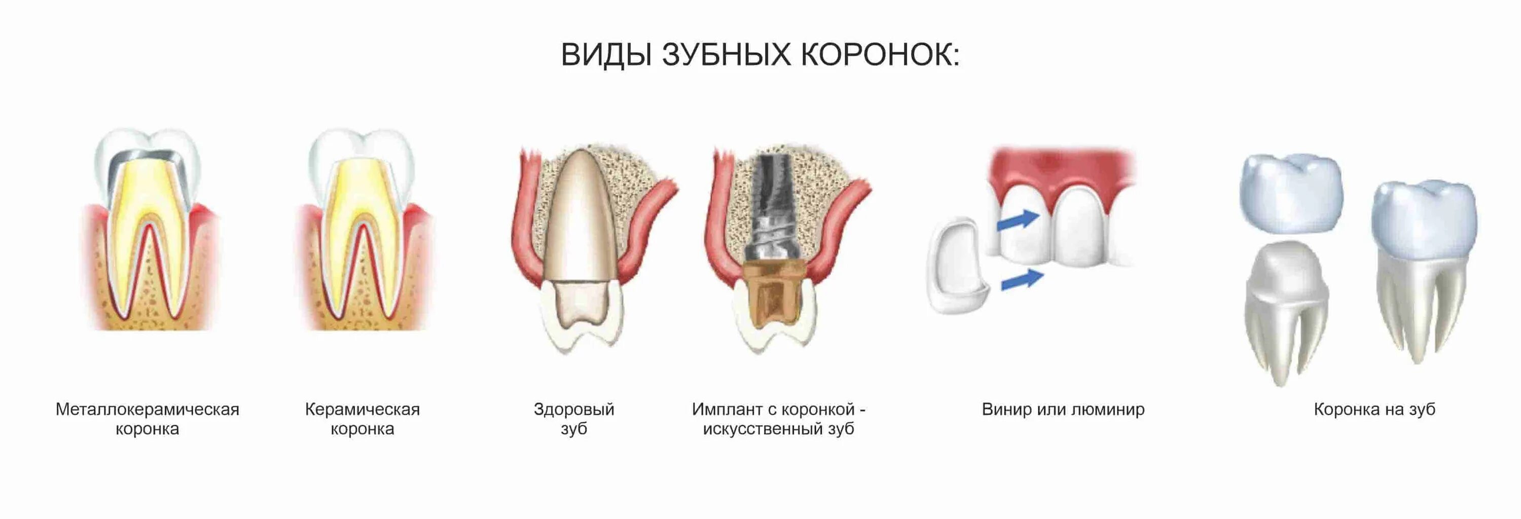 Виды коронок на зубы