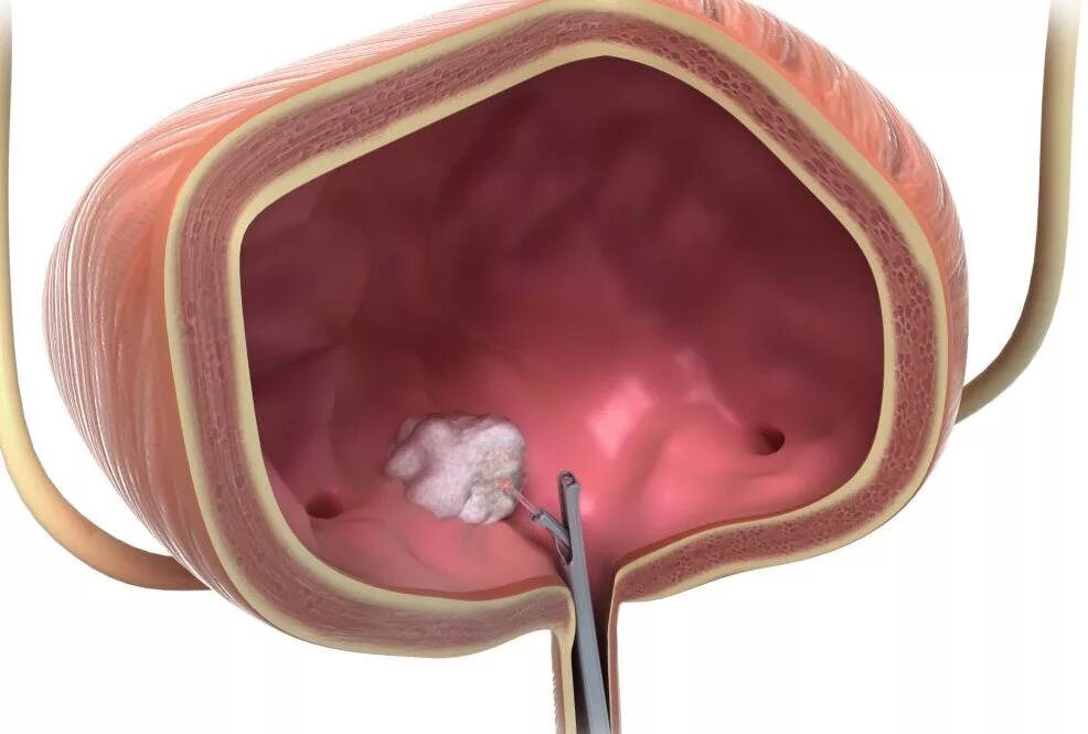 Лечение рака мочевого пузыря у мужчин. Полип мочевого цистоскопия. Опухоль мочевого пузыря цистоскопия. Уретероцеле цистоскопия. Цистоскопия лейкоплакия.
