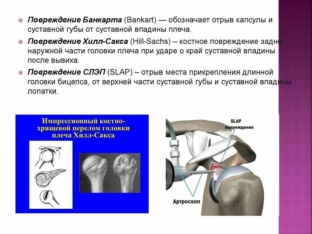 Перелом Банкарта плечевого сустава. Повреждение Банкарта плечевого. Костный Банкарта плечевого сустава.