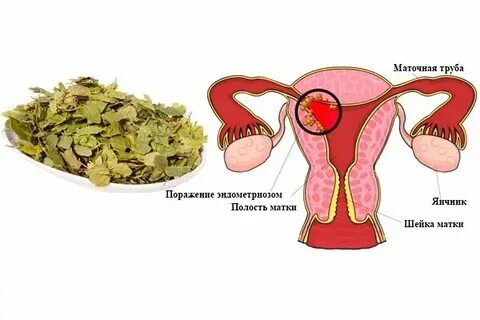 Болит матка после чистки матки