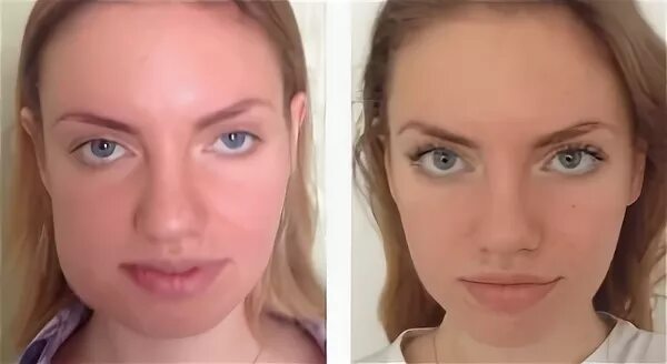 Операция на челюсть до и после. Удаление зуба мудрости опухла щека. Как долго держится отек после удаления. Резекция нижней челюсти до после. Как долго держится отек после удаления.