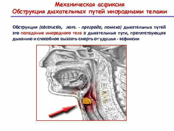 Механическая асфиксия помощь. Обструкция верхних дыхательных путей. Закупорка дыхательных путей инородным телом. Непроходимость верхних дыхательных путей. Механическая асциксии.