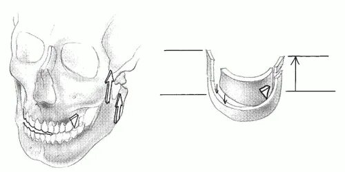 Мыщелки челюсти. Остеосинтез мыщелкового отростка нижней челюсти. Перелом мыщелкового отростка. Перелом суставного отростка челюсти. Мыщелок нижней челюсти.