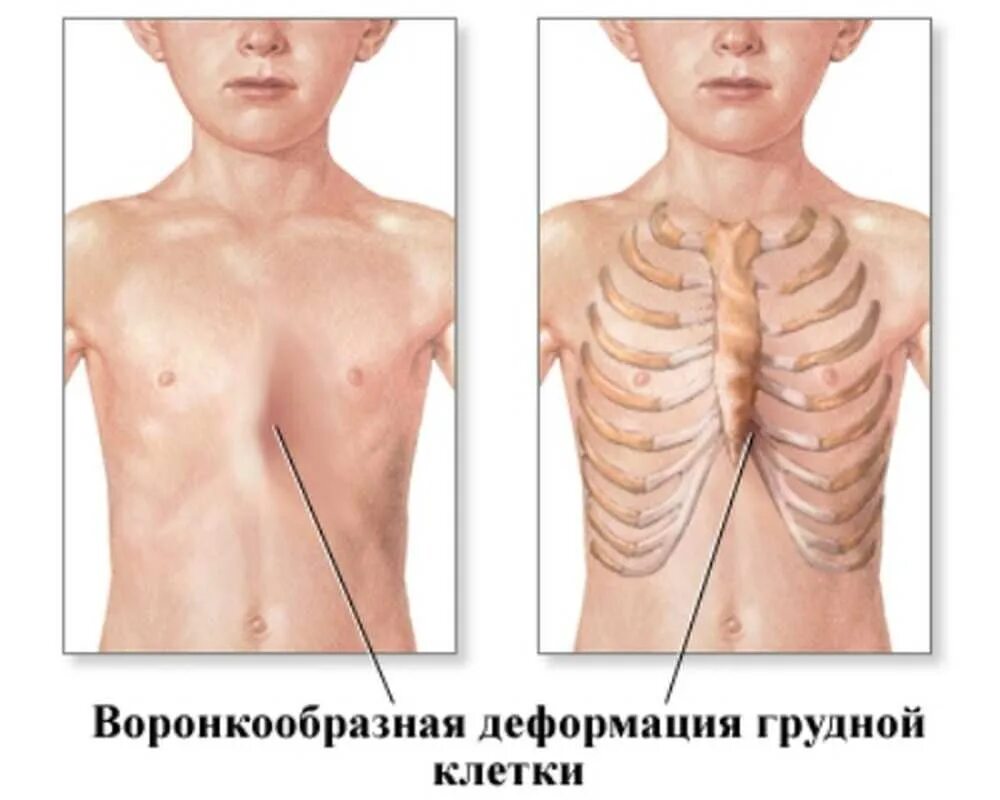 Воронкообразная деформация грудной клетки. Килевидная деформация грудной клетки. Килевидная деформация грудной клетки 2 степени. Воронкообразное искривление грудной клетки.