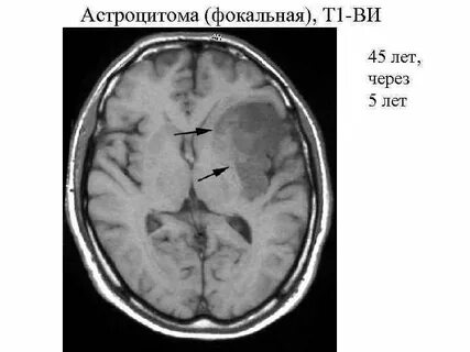 Астроцитома головного мозга операция