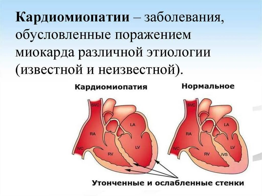 Кардиомиопатия что это такое. Сердечной недостаточности кардиомиопатии. заболевания сердца кардиомиопатии. кардиомиопатия заболевание миокарда. обструктивная дилатационная кардиомиопатия.
