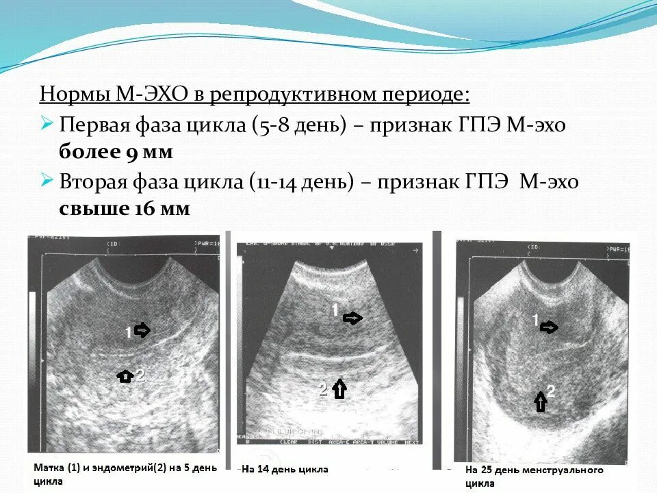 М-Эхо матки мм норма 2 фаза МЦ. Толщина м Эхо в 1 фазу менструального цикла. Эндометрий по УЗИ по фазам цикла. На 5 день цикла эндометрий мм.