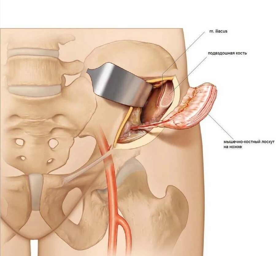 Подвздошная кость болит. Лоскут гребня подвздошной кости. Ость гребня подвздошной кости. Резекция левой подвздошной кости. Подвздошная кость гребень.