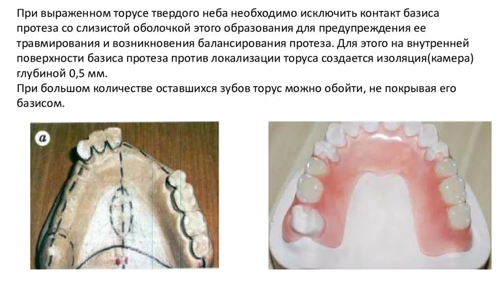 Привести в базисы. Границы базиса ЧСПП на верхней челюсти. Границы базиса протеза на верхней челюсти. Граница базиса протеза на нижней челюсти. Базис частичного съемного протеза.