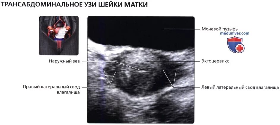 На узи видна шейка матки