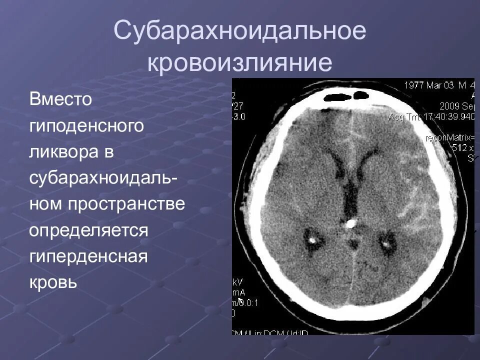Спонтанно кровоизлияние. Субарахноидальное кровоизлияние это инсульт. Осложнения нетравматического субарахноидального кровоизлияния. Субарахноидальное кровотечение на кт. Субарахноидально-паренхиматозное кровоизлияние кт.