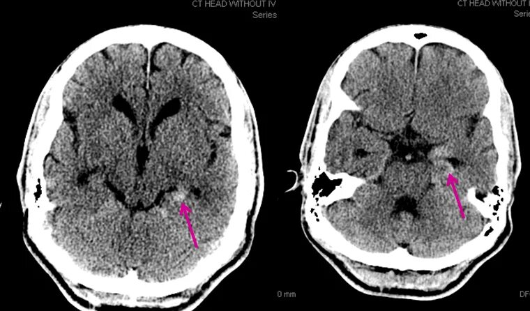 Воспаление серого вещества мозга латынь. Энцефалит Расмуссена мрт. NMDA-рецепторный энцефалит. Мозжечковый энцефалит.