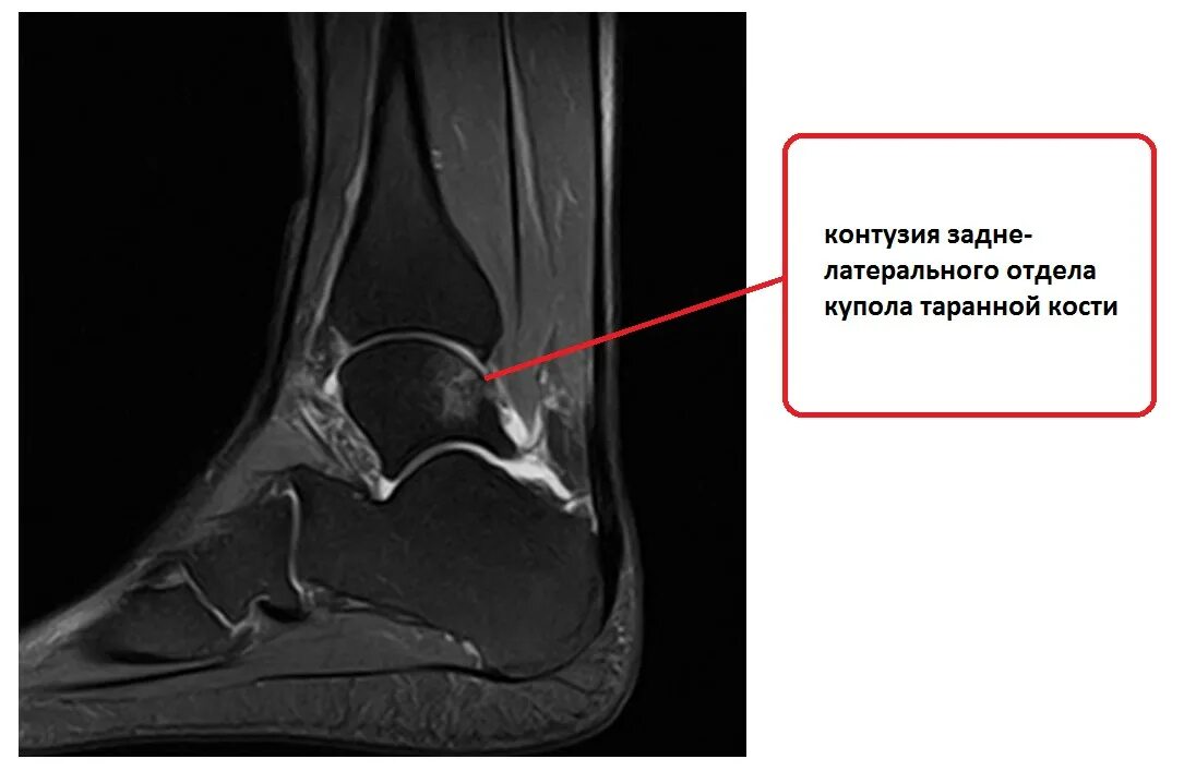 Контузионные изменения кости. Анатомия голеностопного сустава мрт. Латеральная нестабильность голеностопного сустава. Остеомиелит таранной кости мрт. Трабекулярный отек таранной кости.