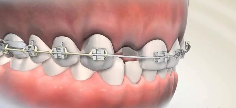 Устанавливают ли. Брекеты. Брекеты для зубов на коронки. Брекеты на отсутствующие зубы.