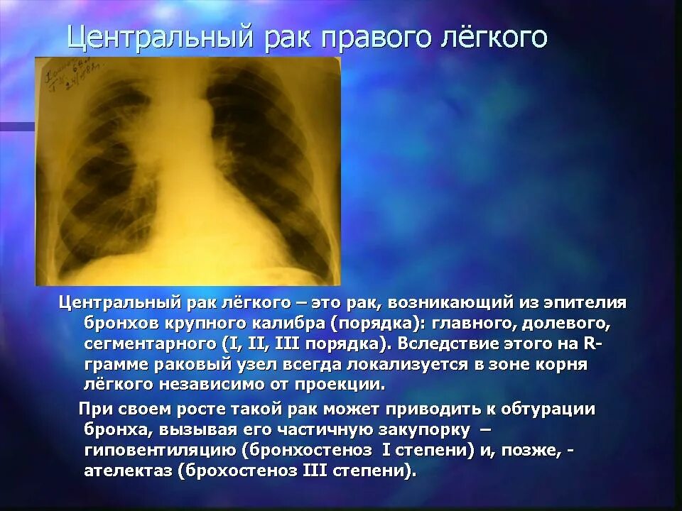 Центральный рак правого. Периферическое образование легкого. Онкология правого легкого. Периферическое образование нижней доли правого легкого что это такое. Периферическое образование в легких что это.