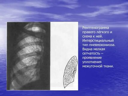 Деформировано легкое