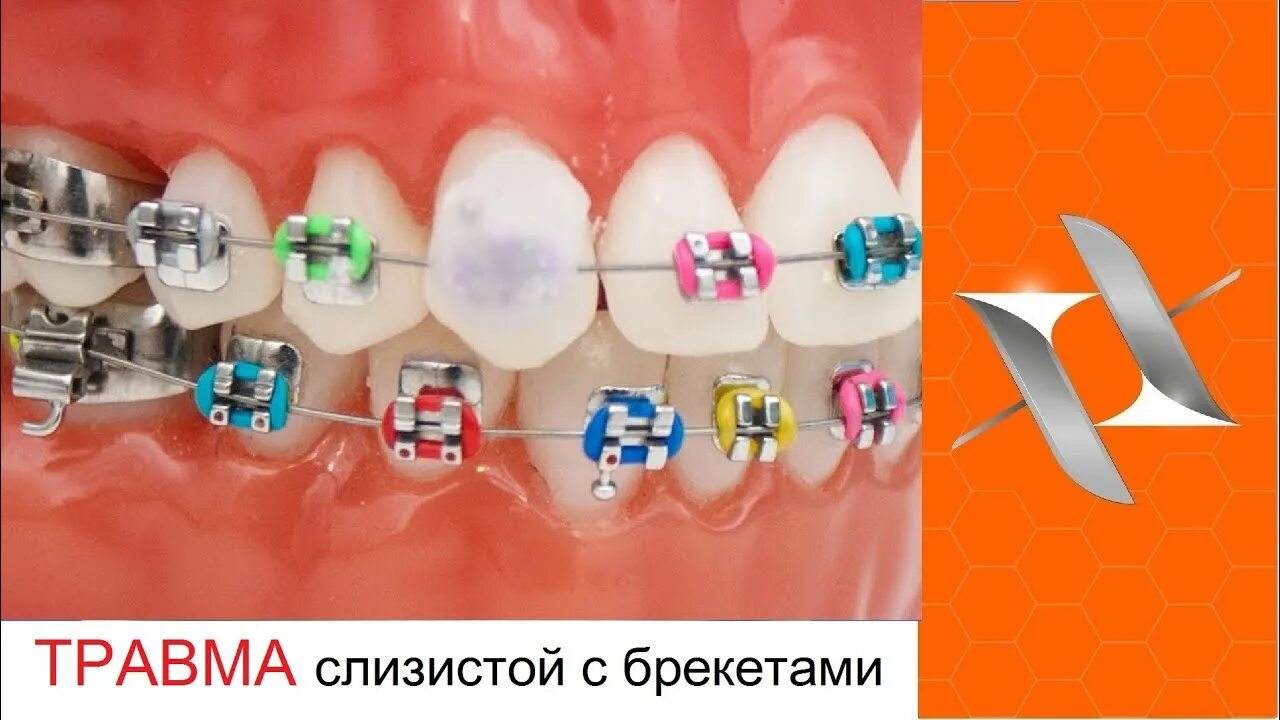 Ортодонтические конструкции. Брекеты спорт. Брекеты спорт. Металлические лигатурные брекеты. Сапфировые самолигирующие брекеты.