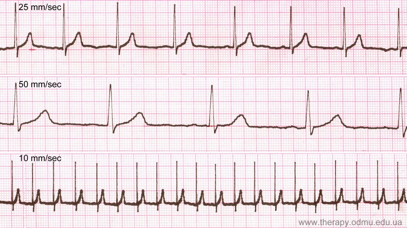 Скорость записи ЭКГ 25 мм с. 10 Мм/МВ В ЭКГ. Скорость записи ЭКГ 50 мм с. ЭКГ 50 мм и 25 мм. Тяжелое экг