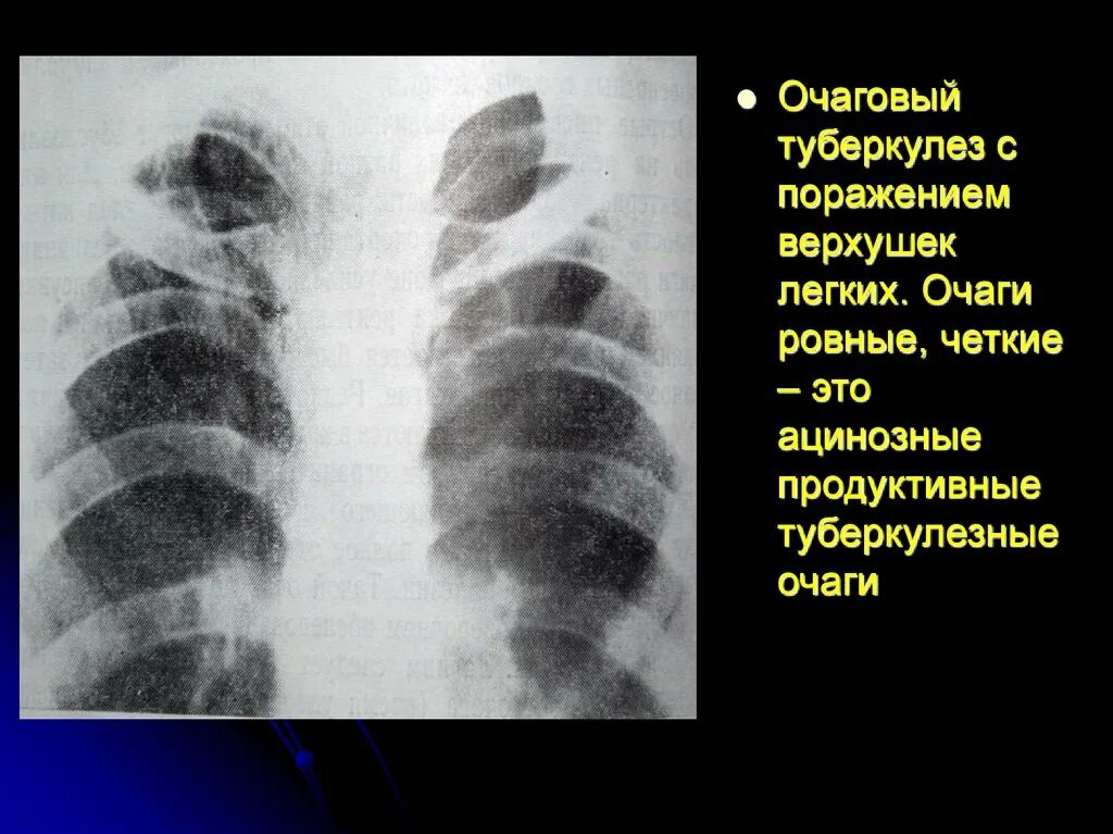 Очаговое поражение легких. Очаговое поражениелегокго. Очаговые поражения лёгких.