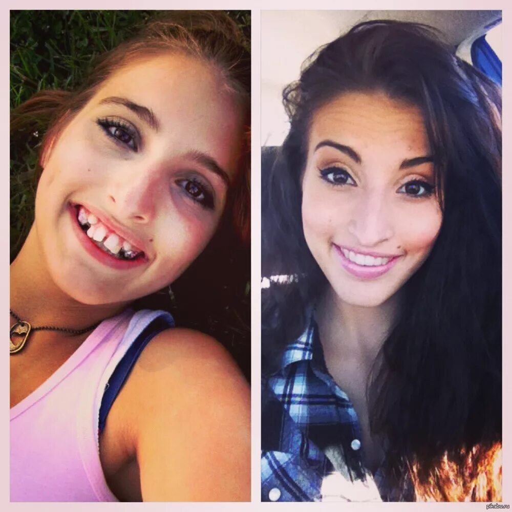 Красивые девушки с брекетами до и после. 21 год разницы