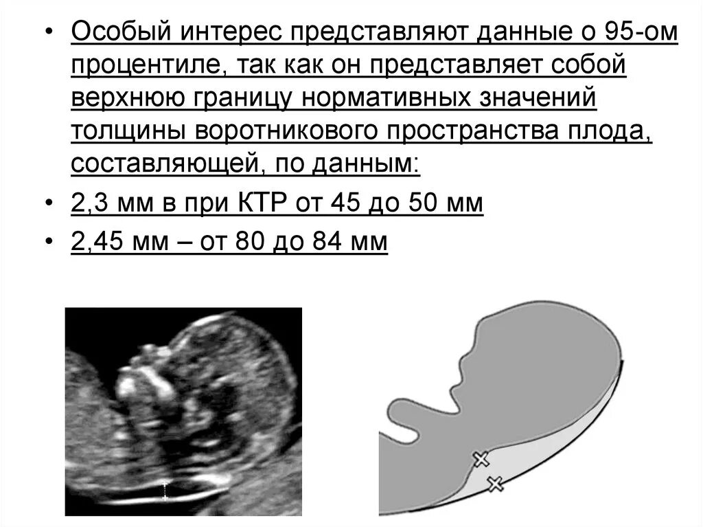 Воротниковое пространство плода норма. ТВП В 13 недель норма таблица. ТВП плода норма в 13 недель беременности. Воротниковое пространство в 13 недель норма таблица. Норма воротникового пространства в 13 недель