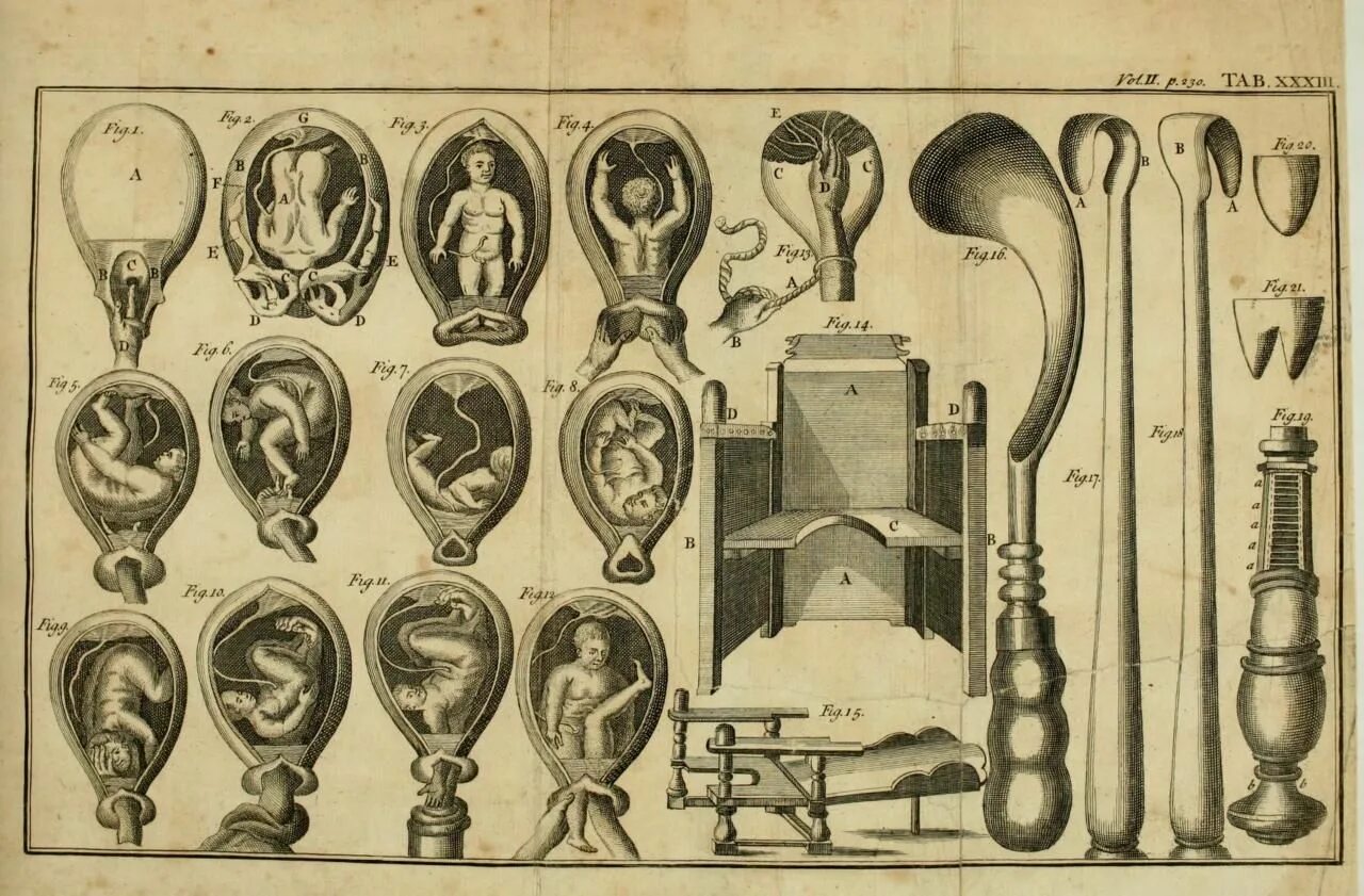 Потапова первые в роду. Инструменты Максимович-Амбодик. Акушерские щипцы 18 век.
