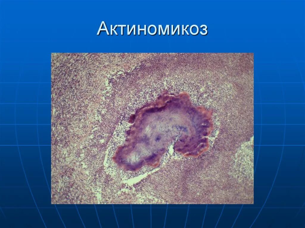Актиномикоз это. Актиномикоз препарат патанатомия. строение актиномикозной гранулемы. актиномикотическая друза. актиномикозная гранулема патанатомия.