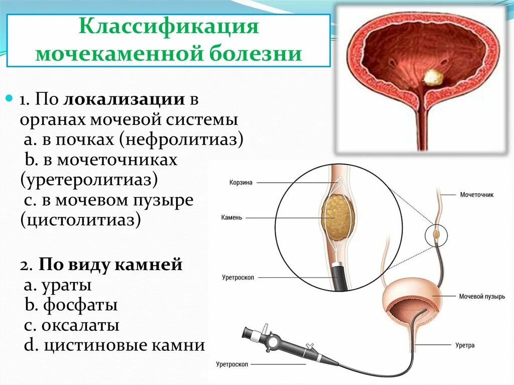 Диффузный мочевой пузырь. Мочекаменная болезнь урология камни мочеточника. Камни почек и мочевого пузыря классификация. Классификация конкрементов при мочекаменной болезни. Форма камней в почках классификация.