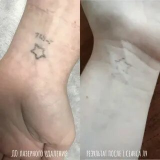 Удаление тату сеансы