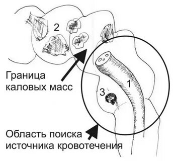 Кишечное кровотечение кал