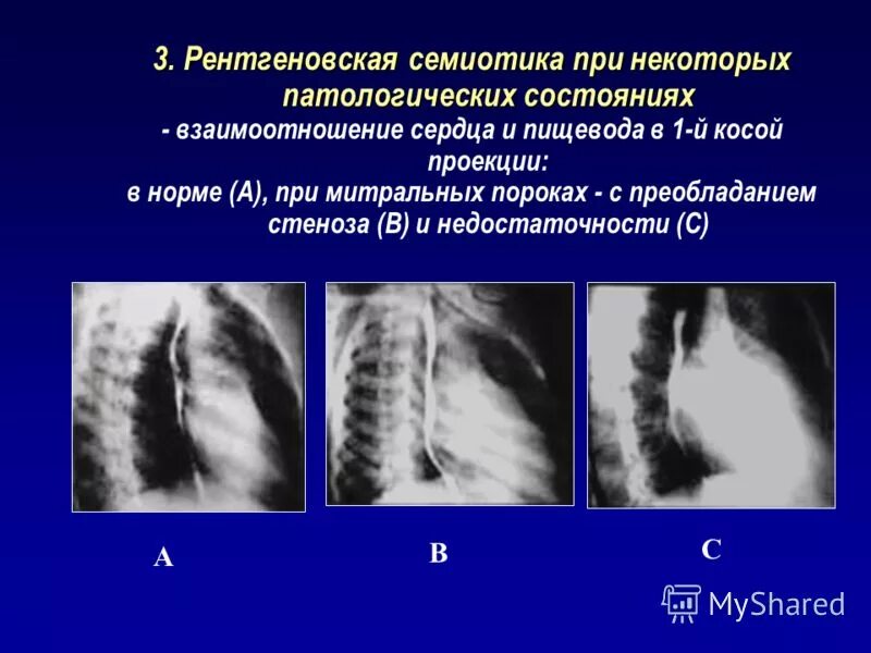 Рентгенограмма желудка в косой проекции. Рентген ребер косая проекция. Аксиальная проекция плечевой кости. Косые проекции рентген. Рентген плеча проекции.