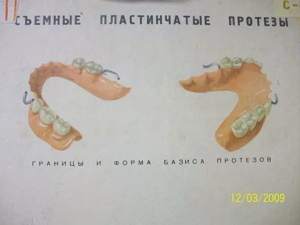 Съемный пластиночный протез этапы. Пластинчатый протез с металлическим базисом. Полный протез с металлическим базисом. Съемный пластиночный протез с металлическим базисом.