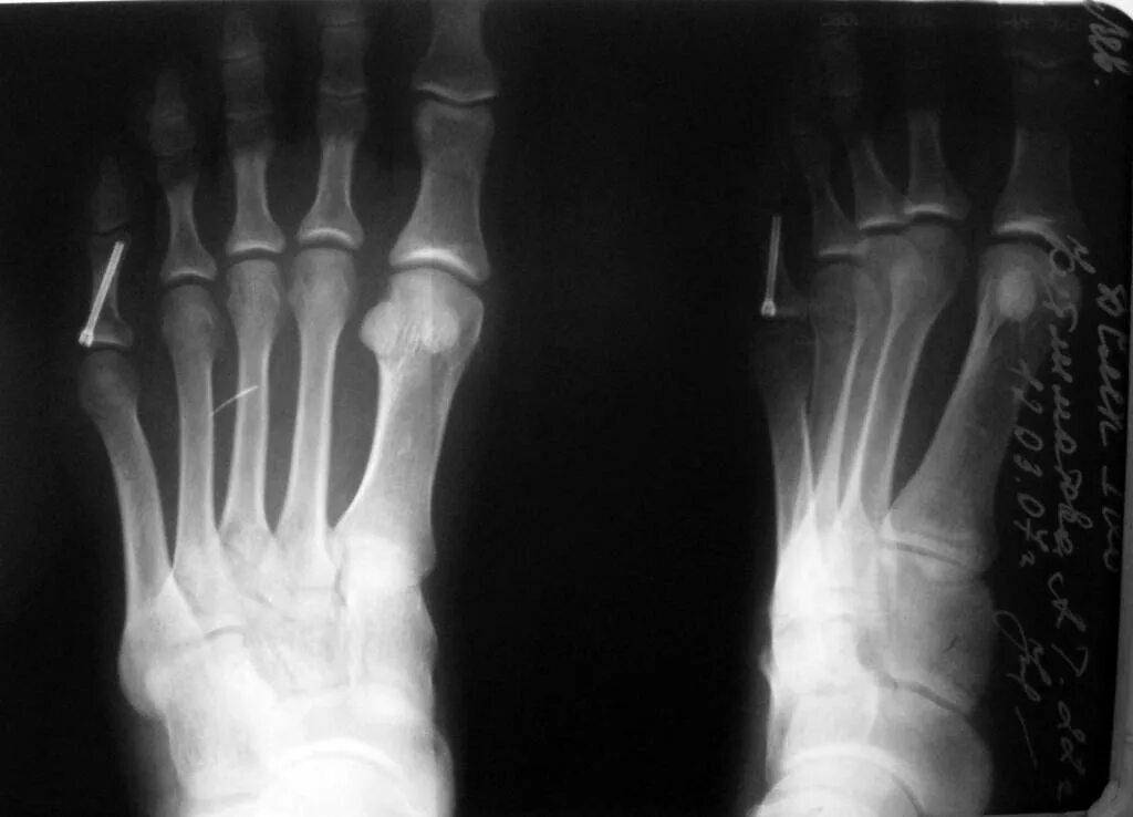 Основные фаланги стопы. Перелом основной фаланги 1 пальца стопы рентген. Перелом проксимальной фаланги стопы. Перелом основной фаланги 5 пальца ноги рентген. Перелом фаланги пальца стопы рентген.