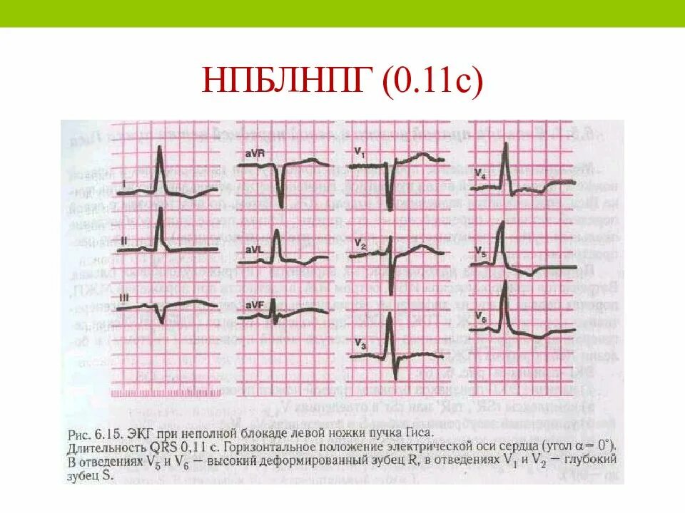 Блокада левой ножки пучка Гиса на ЭКГ. Неполная блокада передней ветви ЛНПГ на ЭКГ. Блокада левой ножки п Гиса на ЭКГ. Блокада передней ветви ЛНПГ на ЭКГ. Левая ножка п гиса