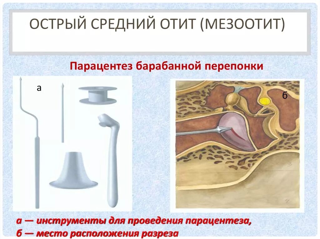 Парацентез барабанной перепонки. Парацентез разрез барабанной перепонки. Парацентез инструменты.