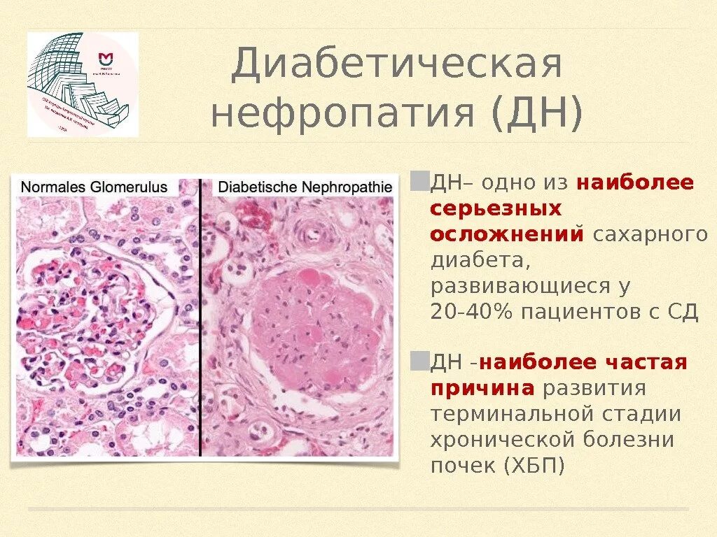 Почечный диабет. Сахарный диабет осложнения патанатомия. патоморфология при диабетической нефропатии. диабетический гломерулосклероз микропрепарат описание. диабетическая нефропатия морфология.