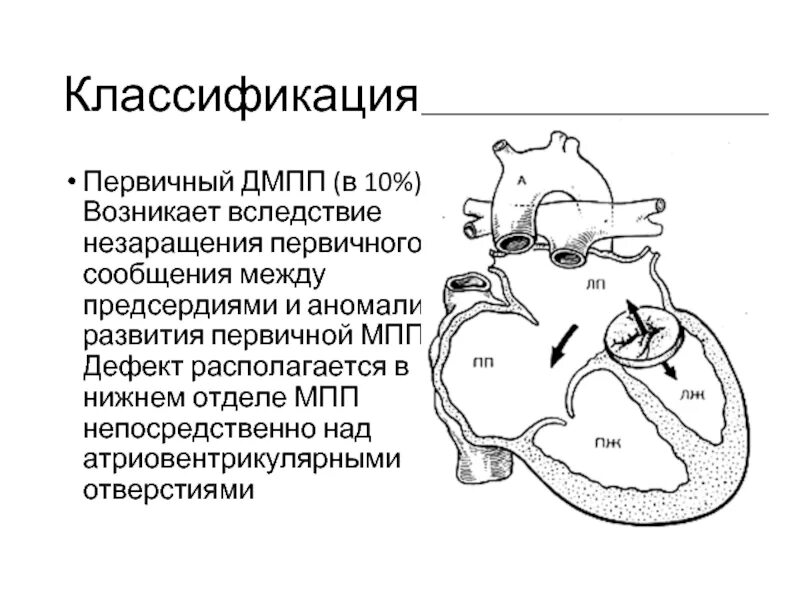 Врожденные пороки сердца дефект межпредсердной перегородки. Первичный дефект межпредсердной перегородки. дефект межпредсердной перегородки (дмпп). первичный и вторичный дефект межпредсердной перегородки разница. первичный дефект межпредсердной перегородки сопровождается.