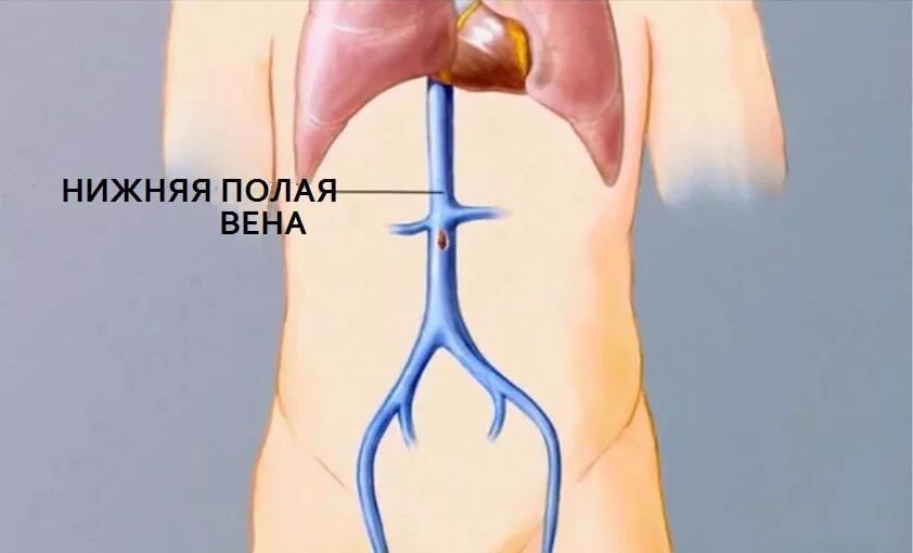 Клапаны нижней полой вены. Тромбоз полой вены фото. Синдром нижней полой вены тромбоз. Нижняя полая Вена тромбоз.