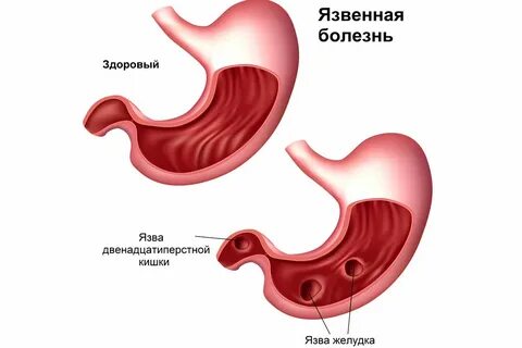 Оптика для осмотра язвы желудка