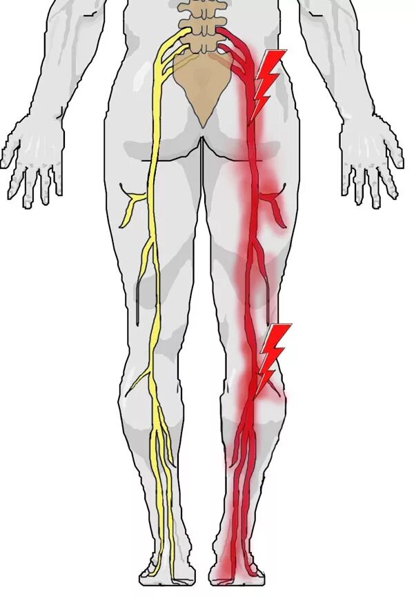 Сильные боли седалищного нерва. Седалищный нерв. Защемление седалищного нерва s1. Схема защемления седалищного нерва. Защемило седалищный нерв симптомы.