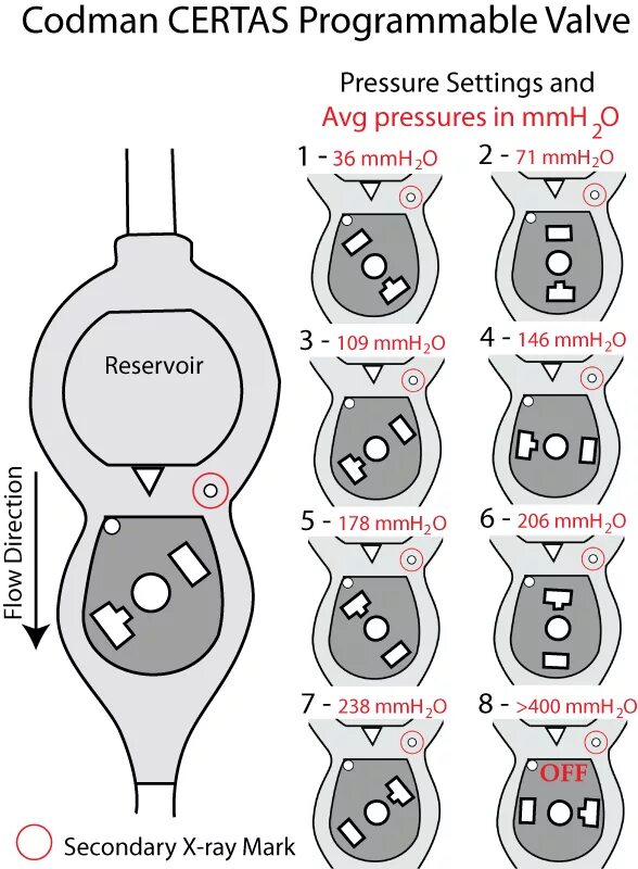 вентрикулярный программируемый шунт. люмбоперитонеальный шунт medtronic. вентрикулярный программируемый шунт. шунт medtronic вентрикулоперитонеальный.