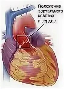 Склероз аортального клапана