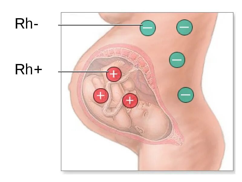 Резус несовместимость крови. Резус несовместимость матери и плода. Резус-фактор. Резус-конфликт. Резус - несовместимости. Несовместимость матери и плода по резус фактору. Болезни генетической несовместимости матери и плода.