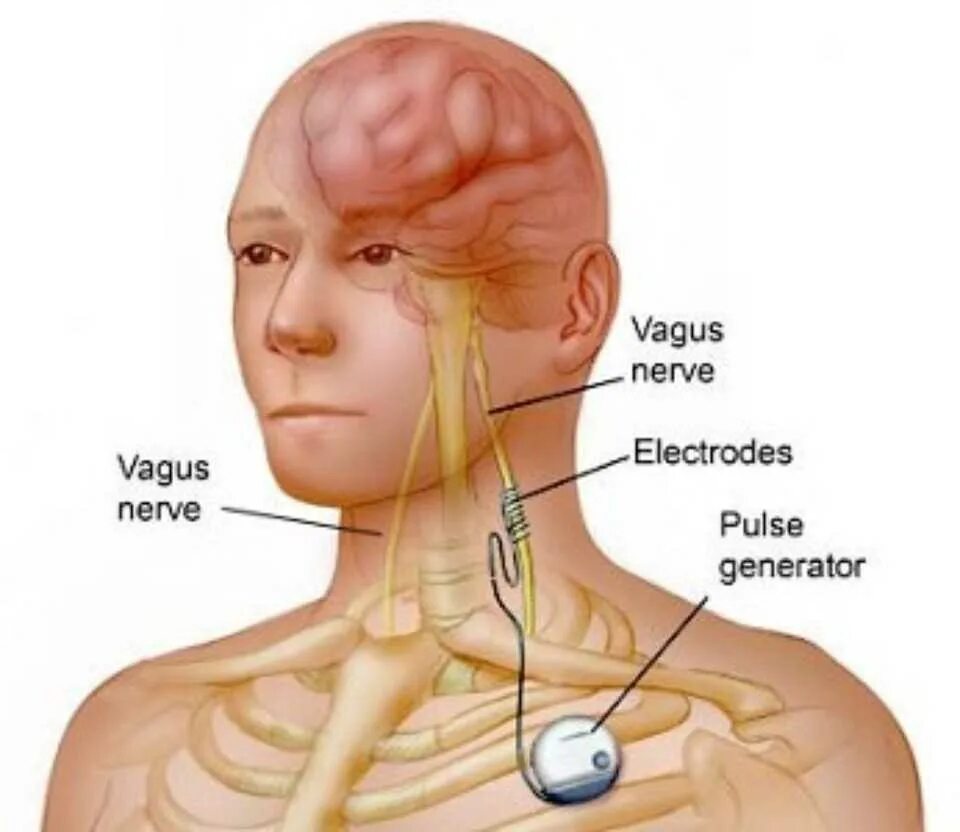 Вагус блуждающий нерв. Нервус вагус блуждающий нерв. Вагус стимулятор блуждающего нерва. Электрическая стимуляция блуждающего нерва.