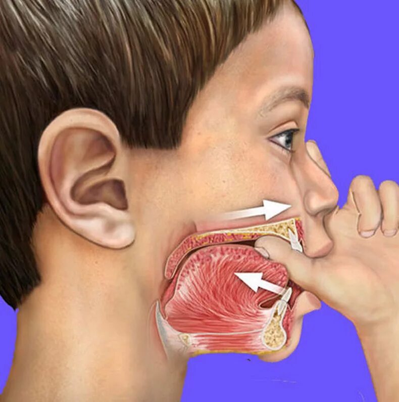Открытыми рот нос и. Деформация челюсти при сосании пальца. Неправильный прикус у ребенка. Прикус при сосании пальца.