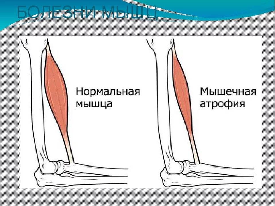 Что такое атрофия мышц. Атрофия скелетных мышц.
