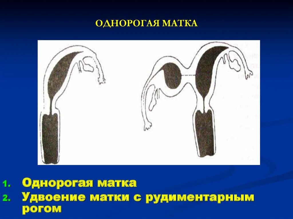 Однорогая и двурогая матка. Однорогая матка с рудиментарным рогом.