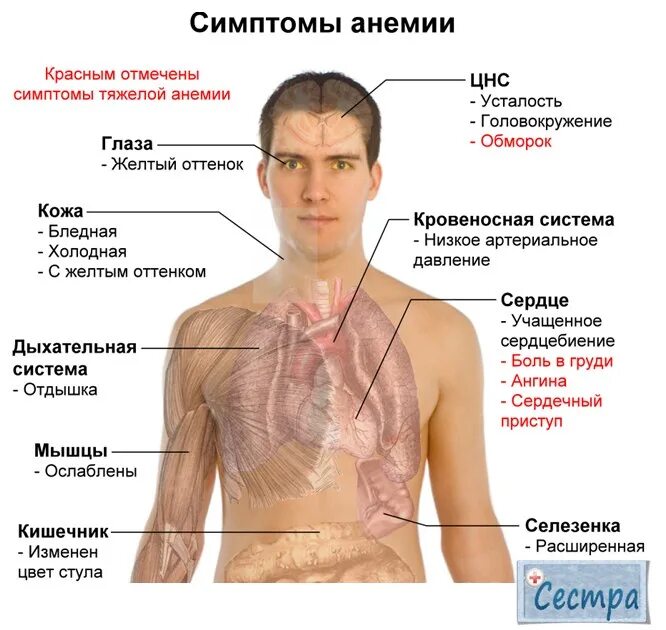 Анемия москве. Дефицит железа симптомы.