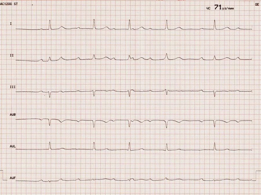 Предсердная блокада. Предсердная тахикардия с АВ блокадой 2:1. Предсердная тахикардия с АВ блокадой 2 степени. Предсердная тахикардия с АВ блокадой 3:1, 4:1. Предсердная тахикардия с АВ блокадой.